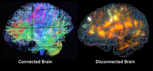 Comparison of connected brain and disconnected brain