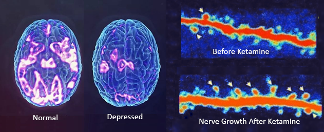 Infographic of normal and depressed brain