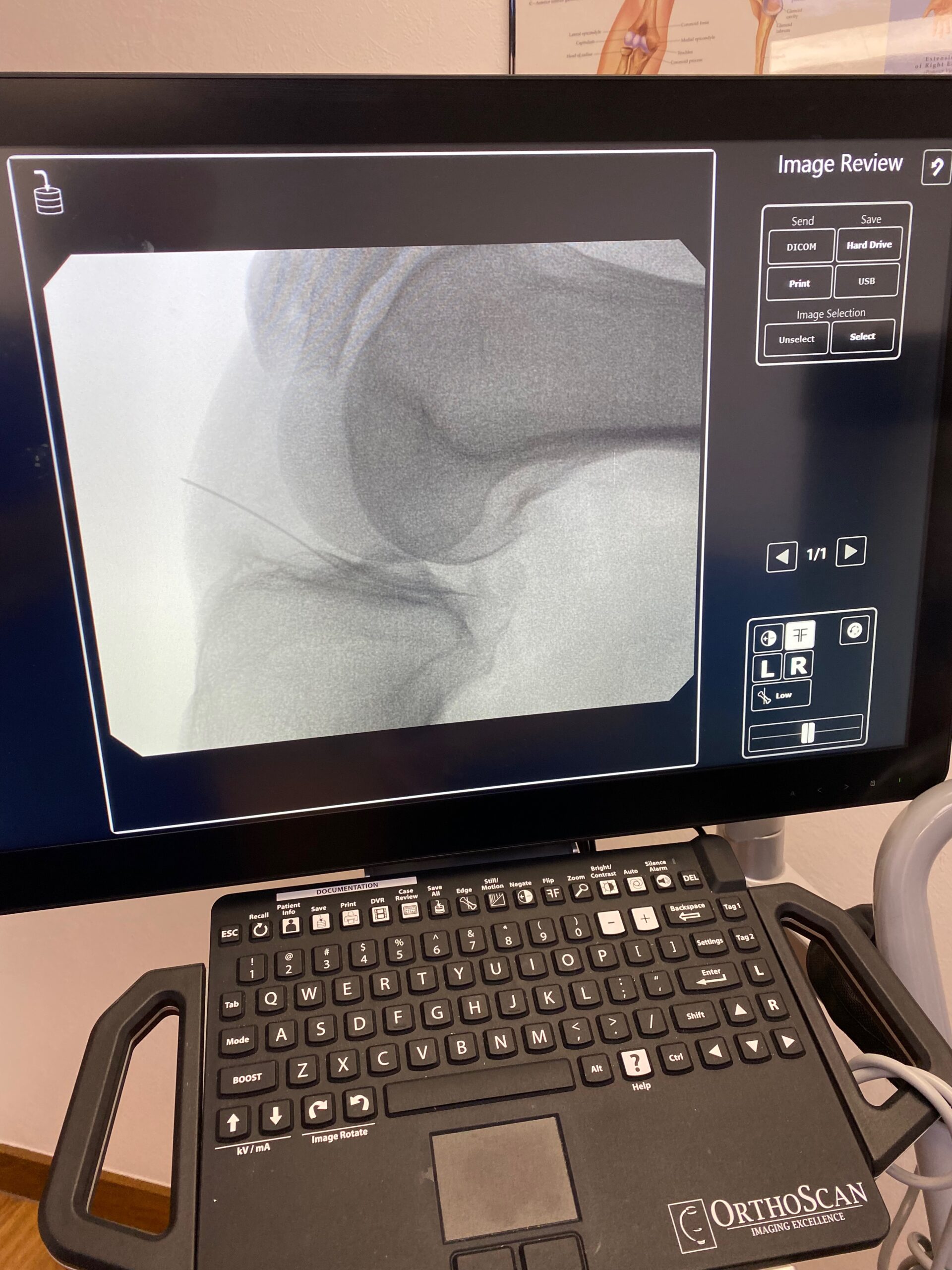 Knee fluoroscopy, Jeffersonville