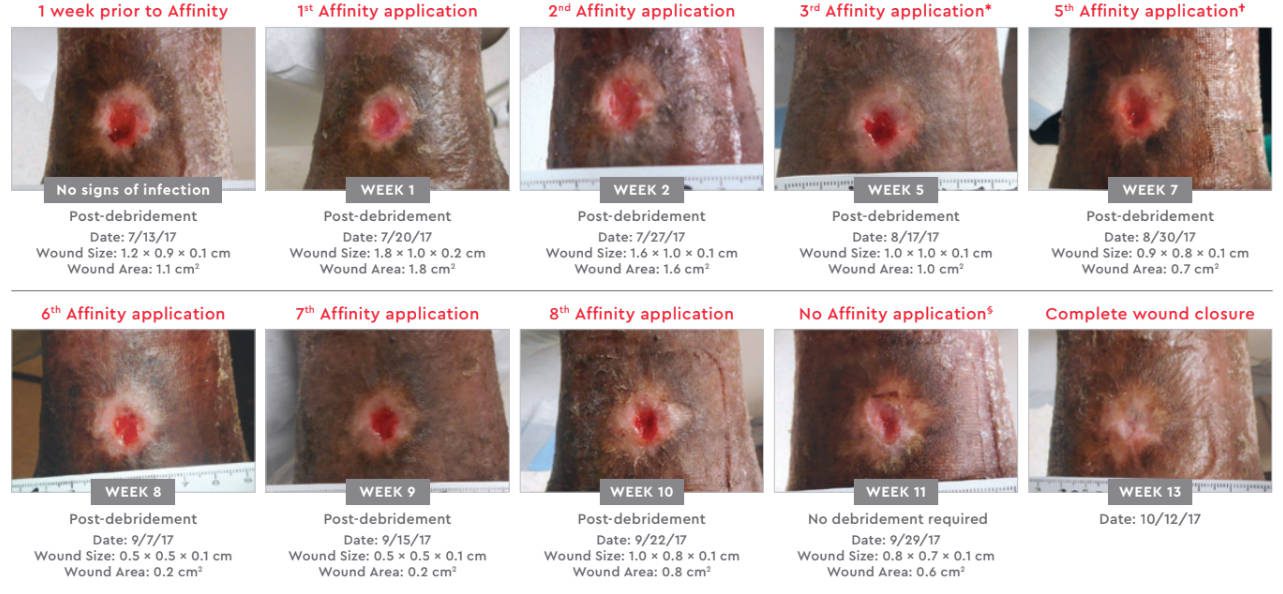 VLU on ankle closed with Affinity